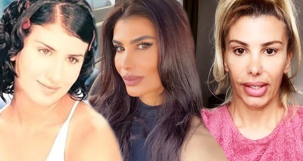 Hatice botokstan zehirlendi! ‘Bunu bir dişçiye yaptırdım’